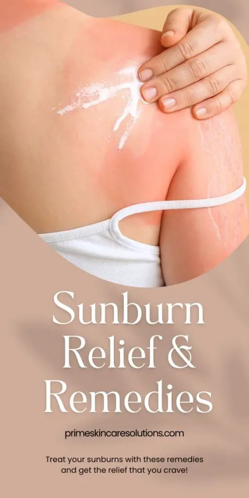 Sunburn Relief and Remedies