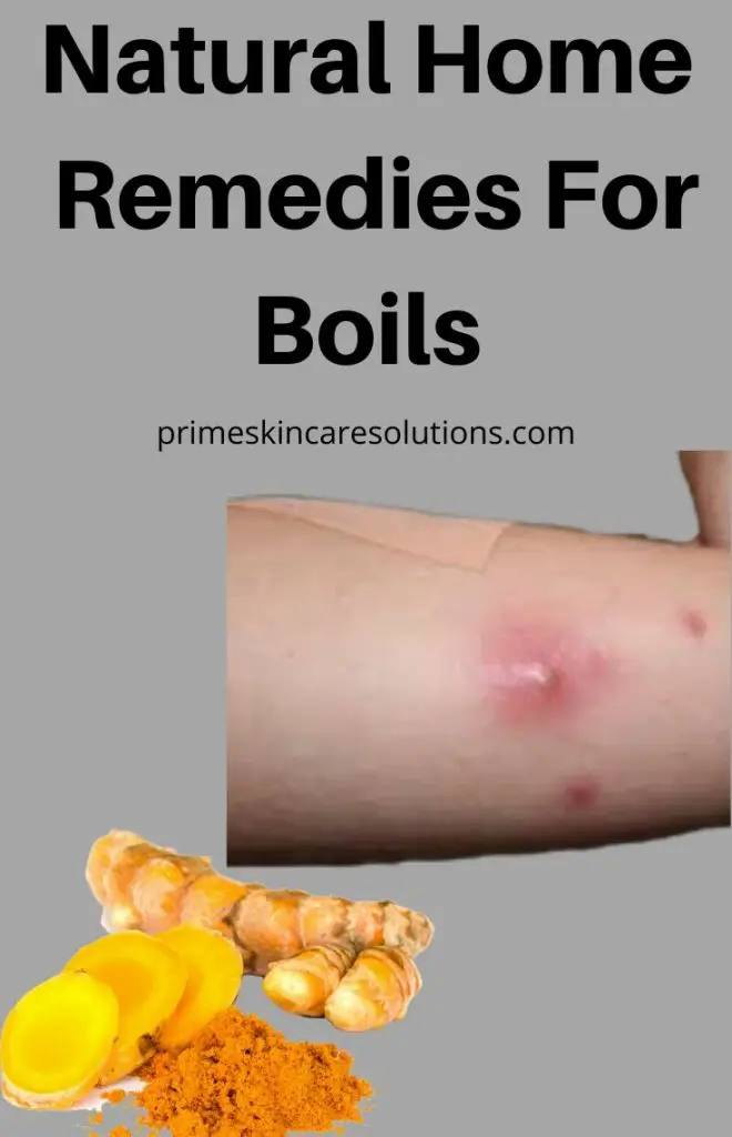 natural home remedies for boils