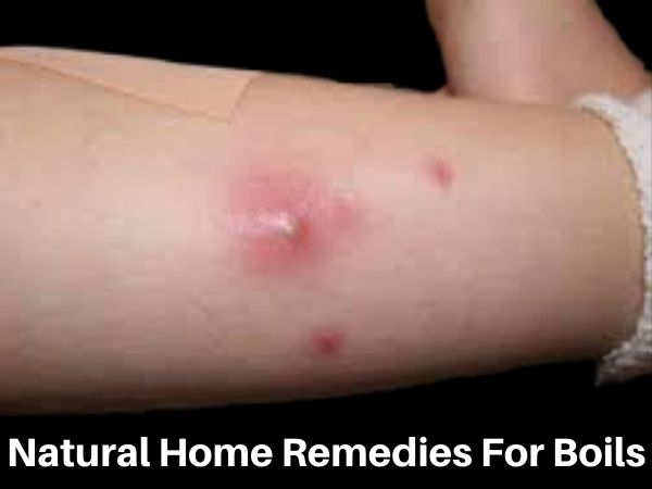 Natural Home Remedies for Boils