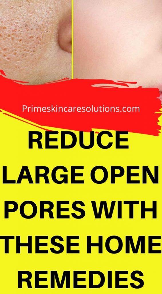 Reduce Large Open Skin Pores Fast With These Home Remedies